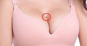 Nốt ruồi ở ngực là tốt hay xấu có nên tẩy